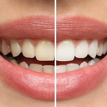 Closeup of patient's teeth before and after whitening their teeth